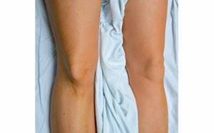 Симптомы вывиха коленного сустава