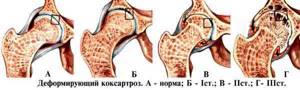 Лечение деформирующего артроза тазобедренного сустава 1, 2 и 3 степени - подробности о болезнях суставов на Diet4Health.ru