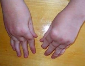 Ревматоидный артрит у детей - подробности о болезнях суставов на Diet4Health.ru