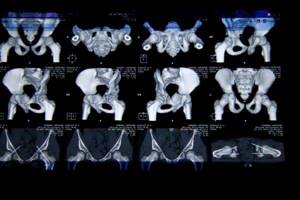УЗИ тазобедренных суставов у новорожденных и взрослых: что показывает и таблица норм углов - подробности о болезнях суставов на Diet4Health.ru