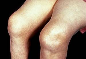 Лечение ревматоидного артрита коленного сустава - подробности о болезнях суставов на Diet4Health.ru