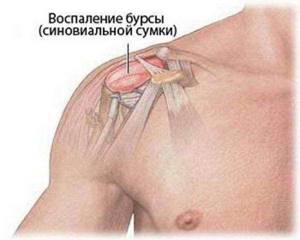 Жидкость в плечевом суставе - подробности о болезнях суставов на Diet4Health.ru