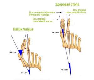 Косточка на большом пальце ноги или вальгусная деформация большого пальца стопы - подробности о болезнях суставов на Diet4Health.ru
