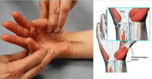 Лигаментит сустава большого пальца руки у взрослых и детей - подробности о болезнях суставов на Diet4Health.ru