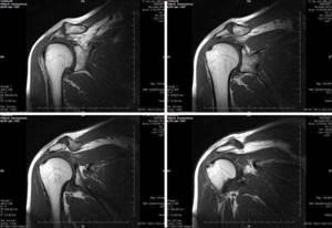МРТ плечевого сустава - подробности о болезнях суставов на Diet4Health.ru