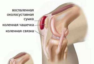 Бурсит колена - подробности о болезнях суставов на Diet4Health.ru Бурсит колена - подробности о болезнях суставов на Diet4Health.ru