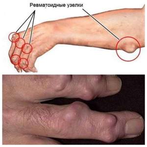 Все что нужно знать о ревматоидном артрите - подробности о болезнях суставов на Diet4Health.ru