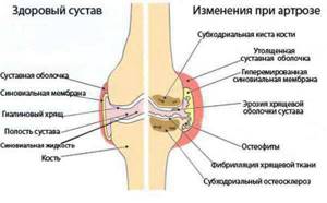 Артроз коленного сустава этиология thumbnail