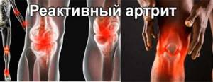 Все что нужно знать о полиартрите суставов - подробности о болезнях суставов на Diet4Health.ru