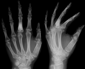 Лигаментит сустава большого пальца руки у взрослых и детей - подробности о болезнях суставов на Diet4Health.ru