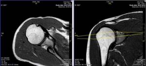 МРТ сустава и мягких тканей плеча - подробности о болезнях суставов на Diet4Health.ru