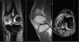МРТ коленного сустава: показания, противопоказания, особенности проведения - подробности о болезнях суставов на Diet4Health.ru