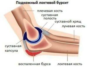 Бурсит локтевого сустава: причины, симптомы, диагностика и лечение - подробности о болезнях суставов на Diet4Health.ru