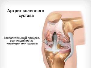 Артропатия коленного сустава: травматическая, нагрузочная, реактивная, детская, перегрузочная - подробности о болезнях суставов на Diet4Health.ru