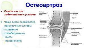Что такое остеоартрит суставов, его симптомы и лечение - подробности о болезнях суставов на Diet4Health.ru Что такое остеоартрит суставов, его симптомы и лечение - подробности о болезнях суставов на Diet4Health.ru