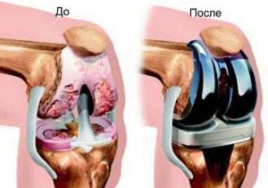 Деформирующий артроз коленного сустава: этиология, клиника, диагностика и лечение - подробности о болезнях суставов на Diet4Health.ru