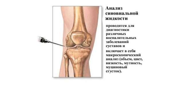 Синовиальная жидкость в коленном суставе: причины возникновения и способы лечения - подробности о болезнях суставов на Diet4Health.ru