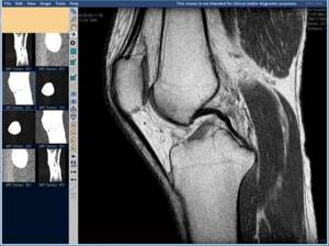 МРТ коленного сустава: показания, противопоказания, особенности проведения - подробности о болезнях суставов на Diet4Health.ru