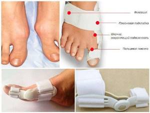 Косточка на большом пальце ноги или вальгусная деформация большого пальца стопы - подробности о болезнях суставов на Diet4Health.ru