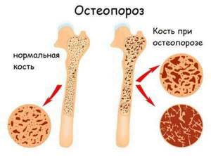 Листья и корень лопуха и при болях в суставах - подробности о болезнях суставов на Diet4Health.ru