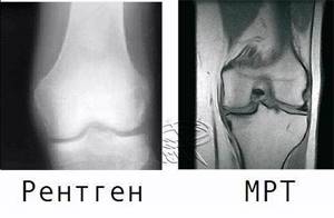 Отличие МРТ от рентгена. Можно ли делать МРТ и рентген в один день? - подробности о болезнях суставов на Diet4Health.ru