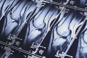 Что такое препателлярный бурсит колена и как его лечить? - подробности о болезнях суставов на Diet4Health.ru