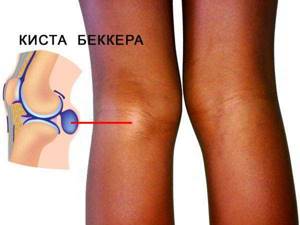 Коксартроз коленного сустава — заболевание которого не существует - подробности о болезнях суставов на Diet4Health.ru