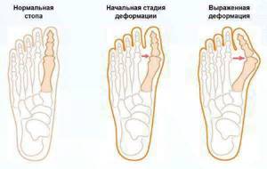 Бурсит большого пальца стопы - подробности о болезнях суставов на Diet4Health.ru