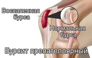 Что такое препателлярный бурсит колена и как его лечить? - подробности о болезнях суставов на Diet4Health.ru