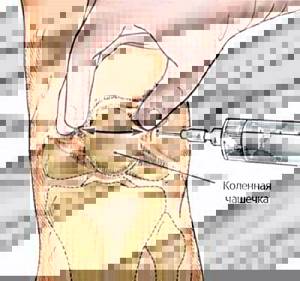 Симптомы и лечение полиартрита плечевого и коленного суставов - подробности о болезнях суставов на Diet4Health.ru
