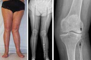 Лечение деформирующего гонартроза коленного сустава 1, 2 и 3 степени - подробности о болезнях суставов на Diet4Health.ru