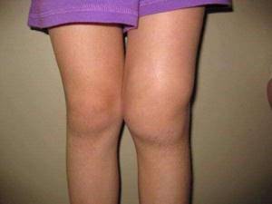 Деформирующий артроз коленного сустава: этиология, клиника, диагностика и лечение - подробности о болезнях суставов на Diet4Health.ru