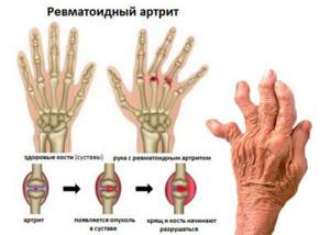 Ревматоидный артрит суставов у женщин - подробности о болезнях суставов на Diet4Health.ru