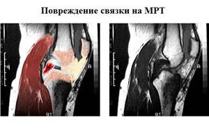 Как проходит и сколько стоит МРТ коленного сустава? Что показывает и сколько времени длиться? - подробности о болезнях суставов на Diet4Health.ru