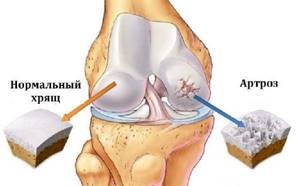 Внутрисуставные инъекции гиалуроновой кислоты в коленный сустав: клиническая эффективность и безопасность - подробности о болезнях суставов на Diet4Health.ru
