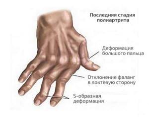 Все что нужно знать о полиартрите суставов - подробности о болезнях суставов на Diet4Health.ru