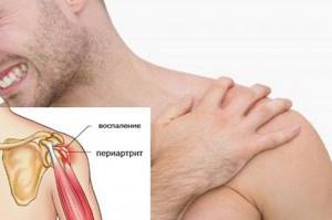Что такое периартроз плечевого сустава и как его лечить? - подробности о болезнях суставов на Diet4Health.ru