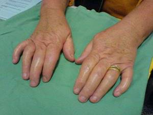 Лечение ДОА лучезапястного сустава 1 и 2 степени, а также мелких суставов кистей рук - подробности о болезнях суставов на Diet4Health.ru