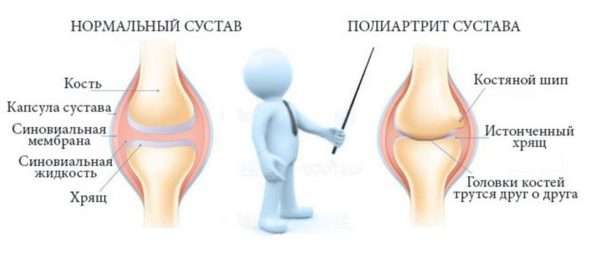 Все о реактивном полиартрите суставов и его разновидностях - подробности о болезнях суставов на Diet4Health.ru