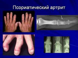 Псориатическая артропатия - подробности о болезнях суставов на Diet4Health.ru