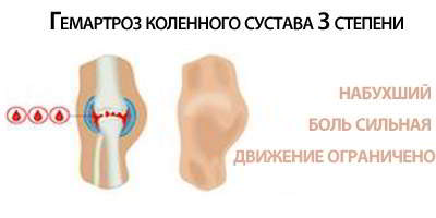 Симптомы и лечение гемартроза коленного сустава - подробности о болезнях суставов на Diet4Health.ru