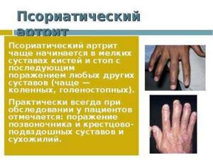 Лечение артроза лучезапястного сустава - подробности о болезнях суставов на Diet4Health.ru