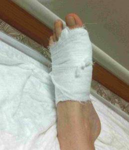 Операция Scarf при искривлении большого пальца на ноге - подробности о болезнях суставов на Diet4Health.ru
