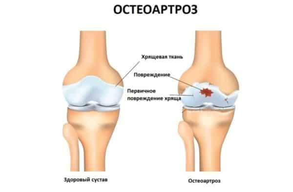 Что такое остеоартрит суставов, его симптомы и лечение - подробности о болезнях суставов на Diet4Health.ru Что такое остеоартрит суставов, его симптомы и лечение - подробности о болезнях суставов на Diet4Health.ru
