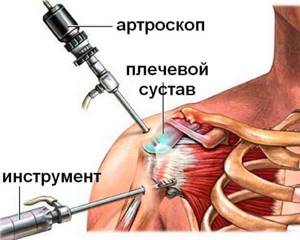 Что такое периартроз плечевого сустава и как его лечить? - подробности о болезнях суставов на Diet4Health.ru