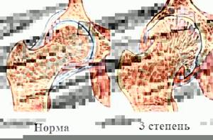 Деформирующий артроз плечевого сустава 1,2 и 3 степени — традиционное лечение и народные средства - подробности о болезнях суставов на Diet4Health.ru