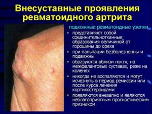 Как ревматоидный артрит влияет на организм? - подробности о болезнях суставов на Diet4Health.ru