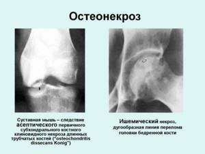 Внутрисуставные инъекции кортикостероидов при гонартрозе - подробности о болезнях суставов на Diet4Health.ru