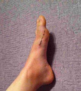 Операция Scarf при искривлении большого пальца на ноге - подробности о болезнях суставов на Diet4Health.ru