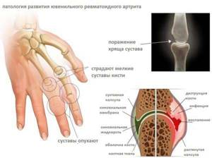 Все что нужно знать о ревматоидном артрите - подробности о болезнях суставов на Diet4Health.ru